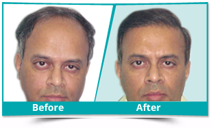 Enhance Clinics Hair Growth Treatments and Hair Transplant Deals