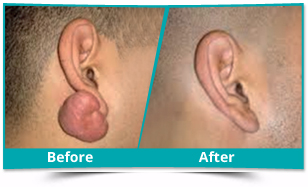 Delhi - Reconstructive Cosmetic Surgery Result
